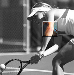 tennis_elbow